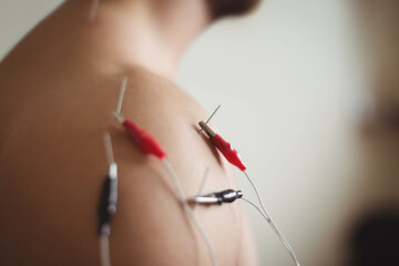 Electro-Acupuncture